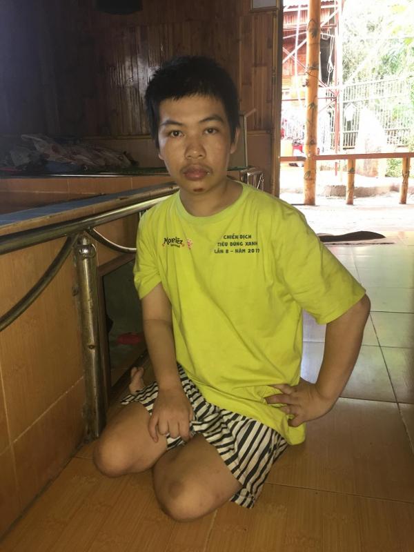 bại não - khuyết tật - Hình mô tả 13