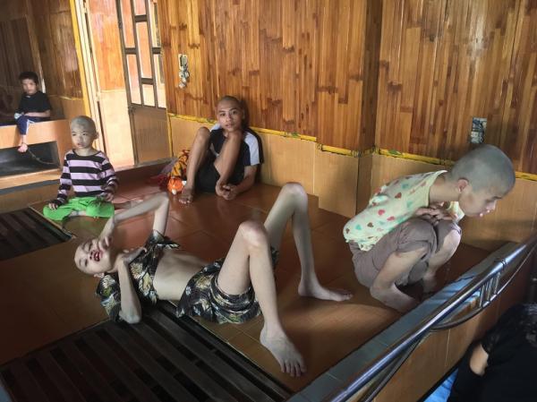 bại não - khuyết tật - Hình mô tả 15