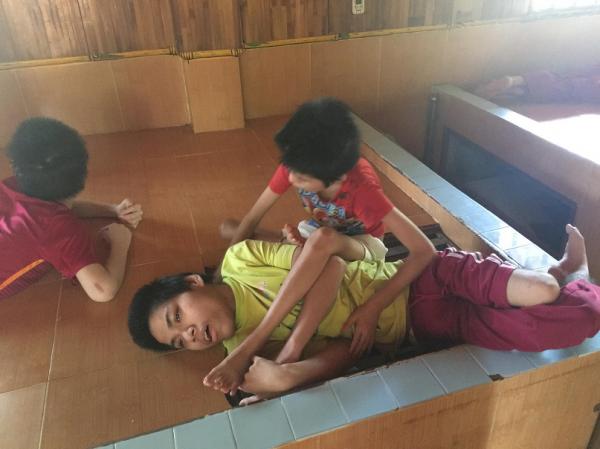 bại não - khuyết tật - Hình mô tả 16