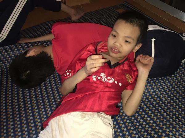 bại não - khuyết tật - Hình mô tả 5