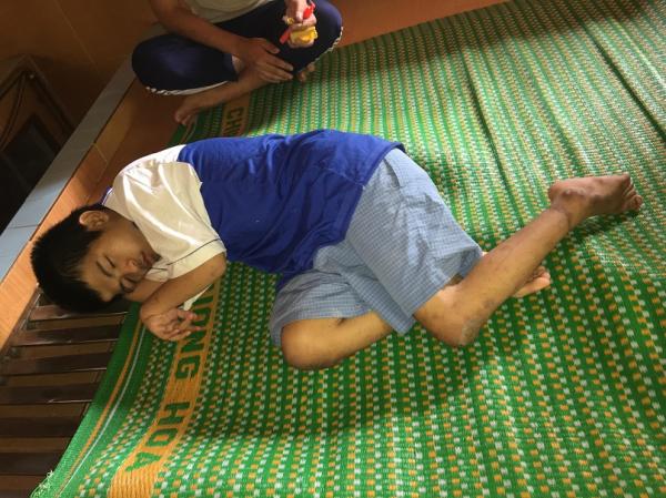 bại não - khuyết tật - Hình mô tả 6